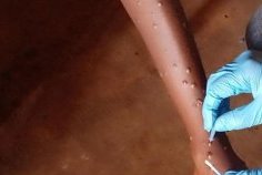 Mpox : l’OMS approuve le premier test de diagnostic pour une utilisation en situation d’urgence