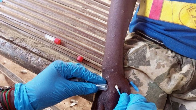 Mpox en Afrique : les enfants particulièrement menacés par la nouvelle variante