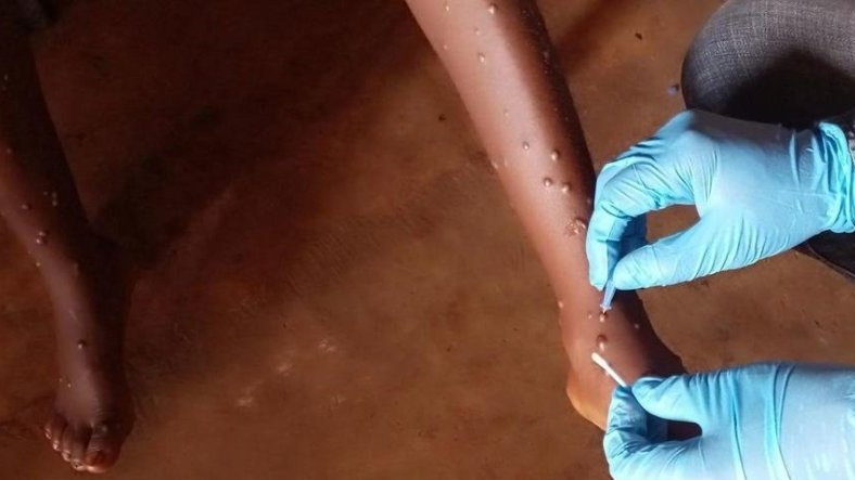 Mpox : l’OMS approuve le premier test de diagnostic pour une utilisation en situation d’urgence